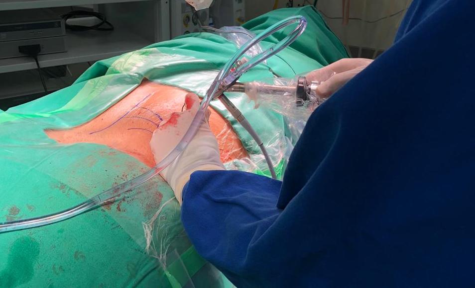 Cirurgia Minimamente Invasiva no tratamento da Hérnia Discal